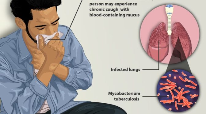 Tuberculosis outbreak in Kansas city