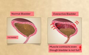 Overactive bladder