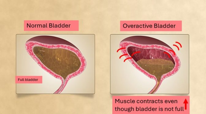 Overactive bladder