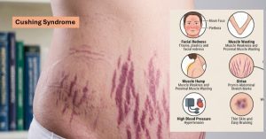 Cushing Syndrome